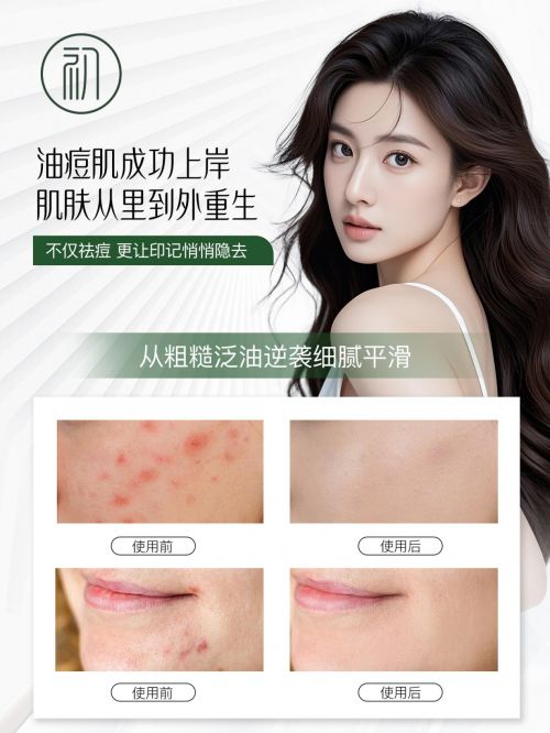 名口碑比较好的祛痘产品攻略请收好AG真人试玩平台祛痘印排行榜第一(图6)